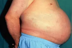 第一个被憋死的人：便秘3年没排泄，重36斤大肠被博物馆收藏图片