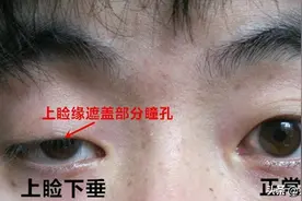 聊一聊上睑下垂常用的手术方法，以及评价和注意事项图片