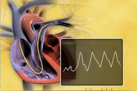 专业资料：心血管Swan-Ganz漂浮导管放置动画视频封面
