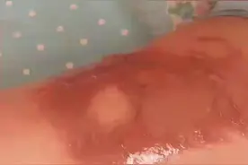 烫伤怎么弄，用了美宝的湿润烧伤膏了，别的不用可以吧