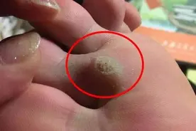 别再为去鸡眼烦恼了，教你一个技巧，不受罪不受痛，自动跑出来