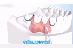 牙齿缺失后，不想做种植牙该怎么办？带你了解活动义齿修复