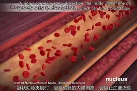 急性冠脉综合症  医学视频视频封面