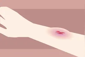 外伤消肿的的最快方法是什么？记住这一点就可以视频封面