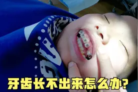 小孩换牙恒牙长不出来咋办？家长花10块钱给做个小手术，立马好了视频封面