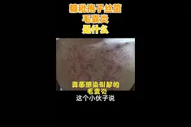 糠秕孢子丝菌毛囊炎是什么？视频封面