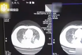 闻臭袜子导致肺部真菌感染？专家建议“超3个月袜子需丢弃”视频封面