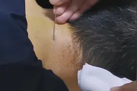 膀子疼痛很多是颈椎病引起，教你如何诊断与针刀治疗视频封面