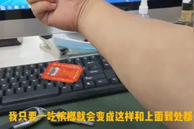 小伙吃了十年槟榔，身体竟然出现这个状况。大家来看看怎么回事。