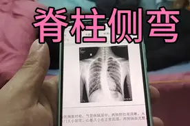 脊柱侧弯，17岁高二生，原因是中午趴在桌子上睡觉。视频封面