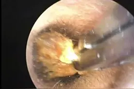 儿童的耵聍清理，11分钟