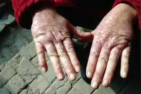 我姐的手上起了好多斑点点，谁有见过吗？或者是有什么土方法医治