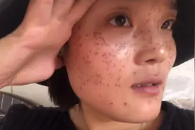 小姐姐中药祛斑每日分享，第三天开始结痂咯，掉痂会留疤吗？