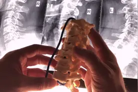 颈椎斜位x光片，可有效帮助发现旋转式错位