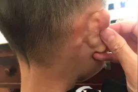 孩子耳朵后面鼓了个硬包，去医院检查医生确这样说，宝妈急坏了视频封面