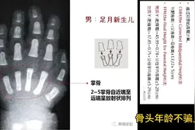 每日影像，#男性骨龄(17岁以内)一览图。实际年龄和骨龄是有差距