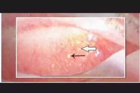 天天追剧 女子眼睛里长满“结石”