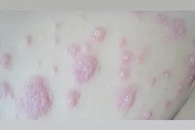 一觉醒来身上突起“小包”，或是螨虫爬上身，除螨妙招要收好视频封面