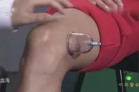 几个穴位就能治疗常年劳损的膝盖？专家现场演示拔罐，一起来看吧视频封面