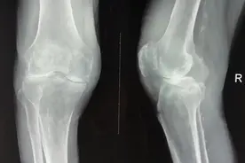 老年膝关节退行性骨关节病，发生的病因，表现，治疗，你了解吗？