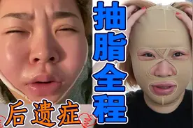 千万别抽脂，实拍全程！瘦了54斤抽脂后我脸僵了！2万买把辛酸泪