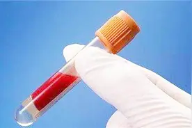 白塞病是如何引起的？化验血能检查出白塞病吗？