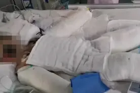 10岁女儿玩火碱重度烧伤单亲妈妈泪崩：女儿3岁时被确诊脑瘫