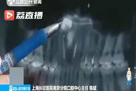 罕见！牙齿逆向生长“跑”到了鼻腔处