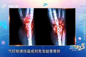 真相123：气钉枪的威力有多大？男子直接造成趾骨骨折，太危险了