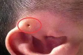 孩子耳朵长了一个"眼"，宝妈好奇就给挤了，医生急道：立马手术视频封面