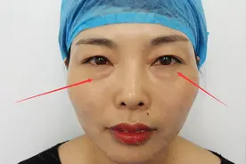 眼袋重太难看，推荐一个妙招，轻松去除，秒变漂亮！视频封面