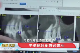 牙齿再生不是梦！女患者报名干细胞再生技术，长出两毫米牙槽骨