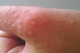 手上脚上长小水泡，越抓越痒？教你简单方法，不花一分钱轻松消除