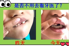 拔牙后凸出来的一大块肉缩回去，也不疼。到底需不需要去看牙医呢视频封面