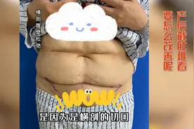 产后妈妈，以剖腹产瘢痕为界限，上下分层，出现双层肚的情况。