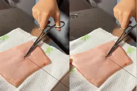 9岁女孩暑假跟医生爸爸学缝合，网友看手法惊呆：比缝纽扣还麻利视频封面