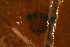 体检发现肝血管瘤，肝血管瘤严不严重，为什么会长肝血管瘤？视频封面