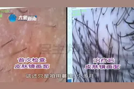 河南郑州：男子深受脱发困扰，就诊后坚持用药，如今效果显著视频封面