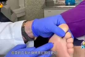新闻大求真：脚底长的痣容易发生癌变，这几种痣一定要及时切除