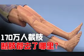 我国有170万人截肢，他们的断肢都怎么处理？答案或超乎你的想象