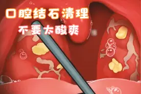 口腔结石清理超解压视频封面