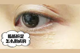 脸上的脂肪粒原来是这么形成的，还不知道的，最好听听专家讲解视频封面