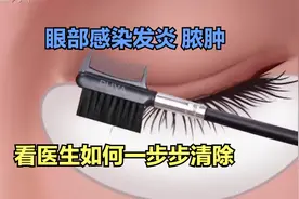医学演绎 人体眼睛被大量细菌微生物感染发炎脓肿怎么办 如何清理