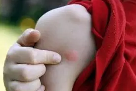 紫草膏除了治湿疹，蚊虫叮咬、烧伤烫伤也好使