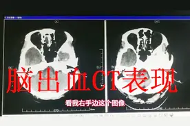 脑出血长什么样？放射科医生带你看脑出血的CT表现