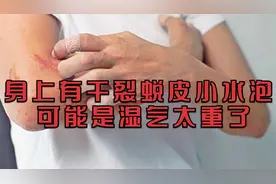 身上手指有干裂蜕皮和小水泡怎么办？可能是湿气太重了