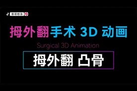 拇外翻手术3D动画，了解手术原理和过程，愿朋友们都身体健康！视频封面