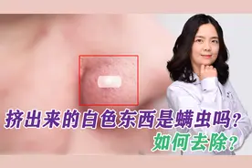 鼻子上挤出来的白色丝状物，到底是啥？皮肤医生教你3招祛除视频封面