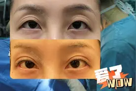 眼皮松弛、多层褶皱、眼窝凹陷，选择了「埋线修复＋开内外眼角」