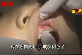 可怜！5岁女童牙齿变色牙龈流脓，医生：因牙神经坏死